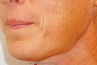 FFS Mandible Contouring Before & After Gallery - Patient 983148 - Image 1