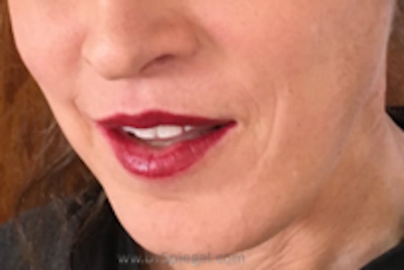 Mandible Contouring Before & After Gallery - Patient 160394 - Image 2