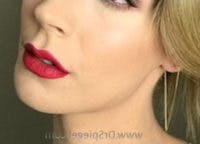 Mandible Contouring Before & After Gallery - Patient 814433 - Image 2