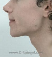 Mandible Contouring Before & After Gallery - Patient 688657 - Image 1
