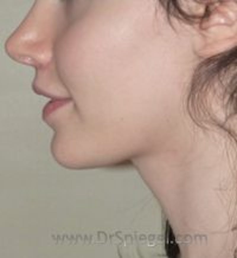 Mandible Contouring Before & After Gallery - Patient 688657 - Image 2