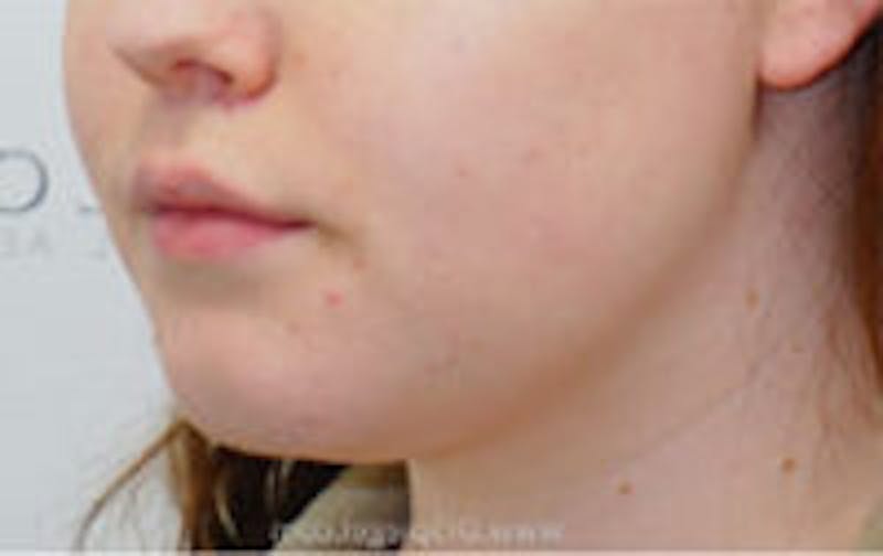 Mandible Contouring Before & After Gallery - Patient 230874 - Image 1