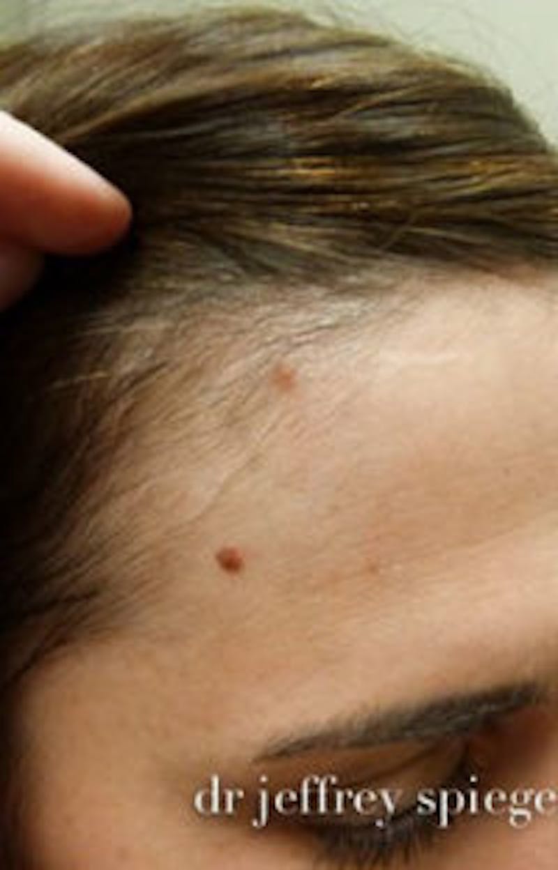 Mole Removal Before & After Gallery - Patient 787210 - Image 1