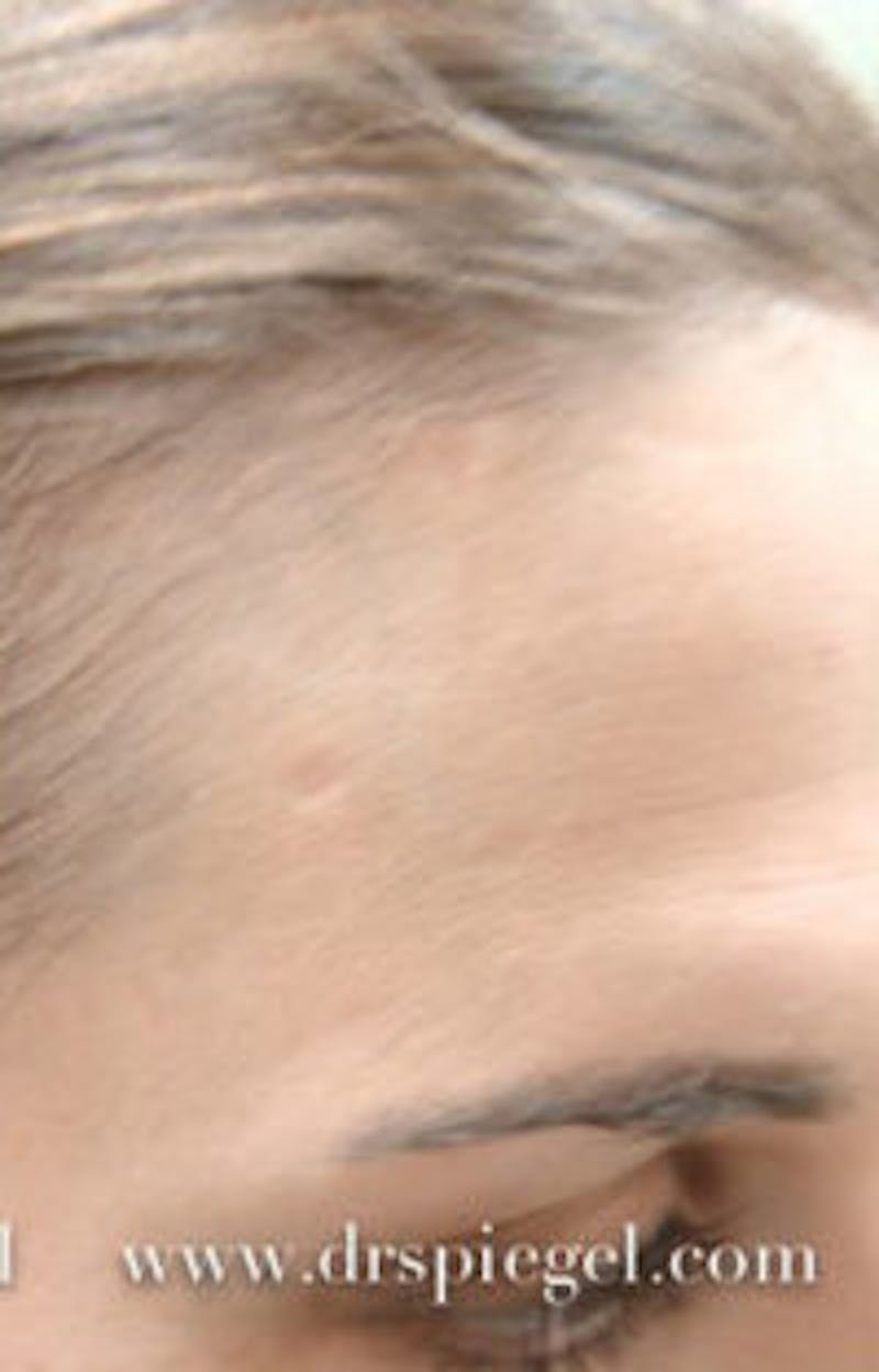 Mole Removal Before & After Gallery - Patient 787210 - Image 2