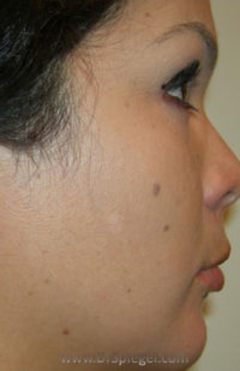 Mole Removal Before & After Gallery - Patient 311873 - Image 2
