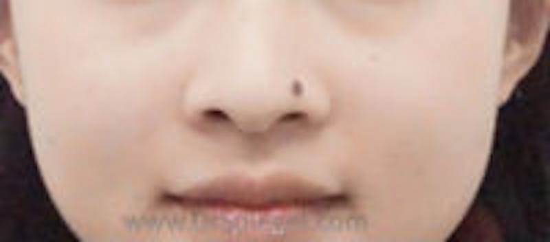 Mole Removal Before & After Gallery - Patient 420754 - Image 1