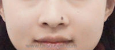 Mole Removal Before & After Gallery - Patient 420754 - Image 1