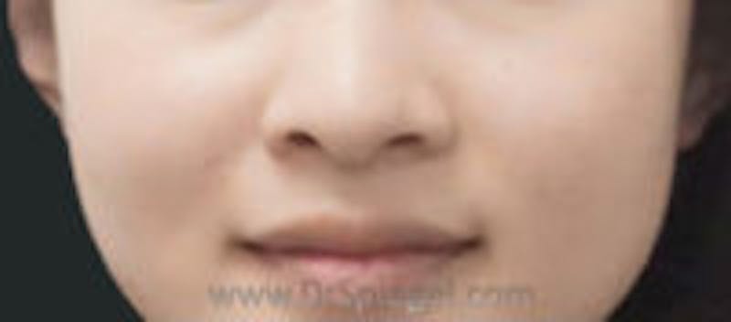 Mole Removal Before & After Gallery - Patient 420754 - Image 2