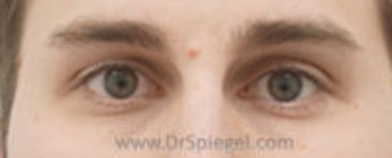 Mole Removal Before & After Gallery - Patient 178358 - Image 1