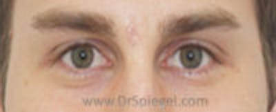 Mole Removal Before & After Gallery - Patient 178358 - Image 2