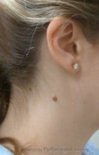Mole Removal Before & After Gallery - Patient 444039 - Image 1