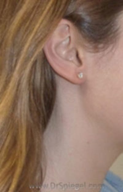 Mole Removal Before & After Gallery - Patient 444039 - Image 2