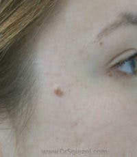 Mole Removal Before & After Gallery - Patient 338611 - Image 1