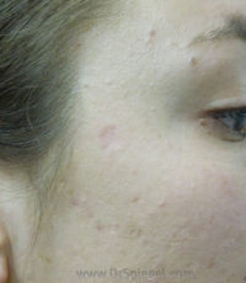 Mole Removal Before & After Gallery - Patient 338611 - Image 2