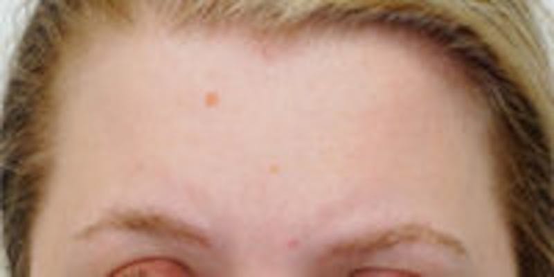 Mole Removal Before & After Gallery - Patient 391237 - Image 1