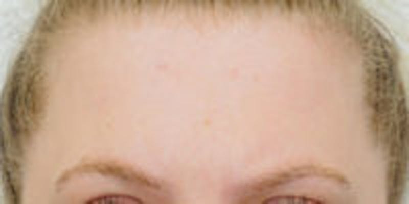 Mole Removal Before & After Gallery - Patient 391237 - Image 2
