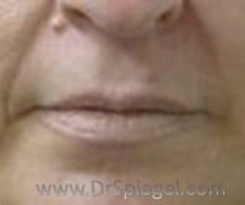 Mole Removal Before & After Gallery - Patient 233273 - Image 1