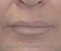 Mole Removal Before & After Gallery - Patient 233273 - Image 2