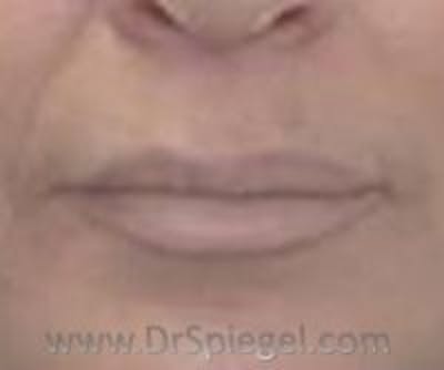 Mole Removal Before & After Gallery - Patient 233273 - Image 2