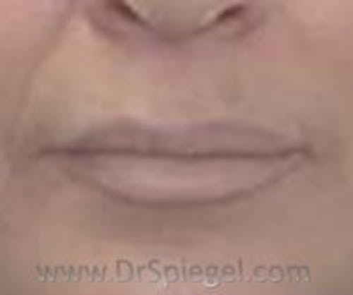 Mole Removal Before & After Gallery - Patient 233273 - Image 2