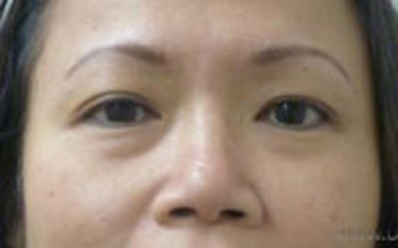 Monolid / Double Eyelid Surgery Before & After Gallery - Patient 405485 - Image 1