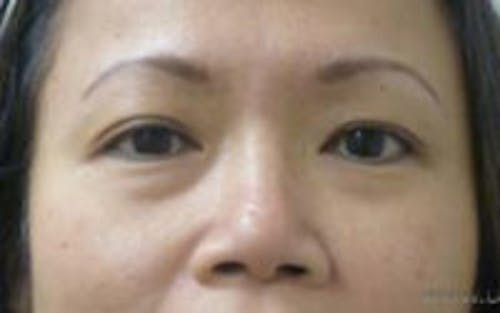 Monolid / Double Eyelid Surgery Before & After Gallery - Patient 405485 - Image 1