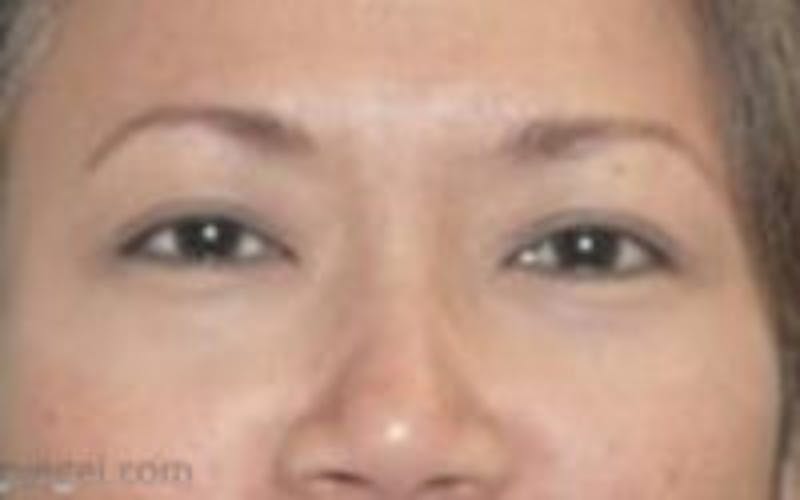 Monolid / Double Eyelid Surgery Before & After Gallery - Patient 405485 - Image 2