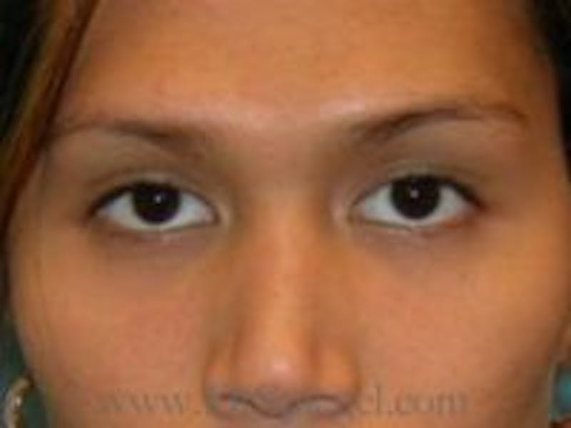 Monolid / Double Eyelid Surgery Before & After Gallery - Patient 378740 - Image 1