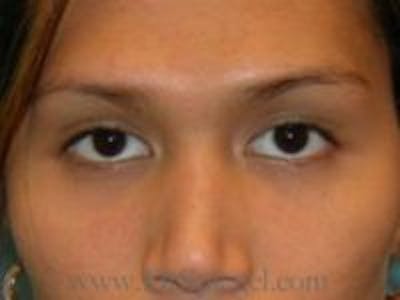Monolid/Double Eyelid Surgery Before & After Gallery - Patient 140445 - Image 1
