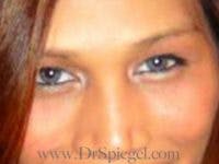 Monolid / Double Eyelid Surgery Before & After Gallery - Patient 378740 - Image 2