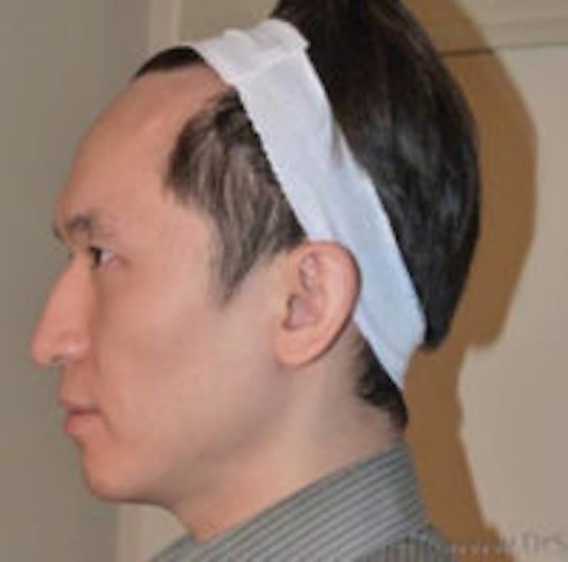 FFS Scalp Advancement Before & After Gallery - Patient 101806 - Image 1