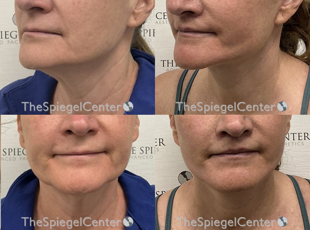 Neck Lift Before & After Gallery - Patient 954523 - Image 1