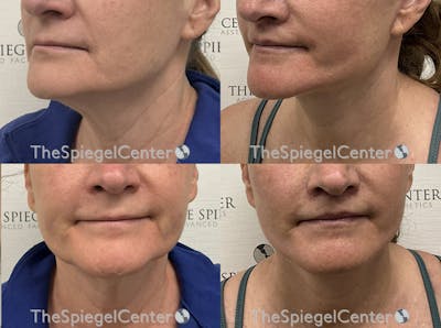 Neck Lift Before & After Gallery - Patient 954523 - Image 1