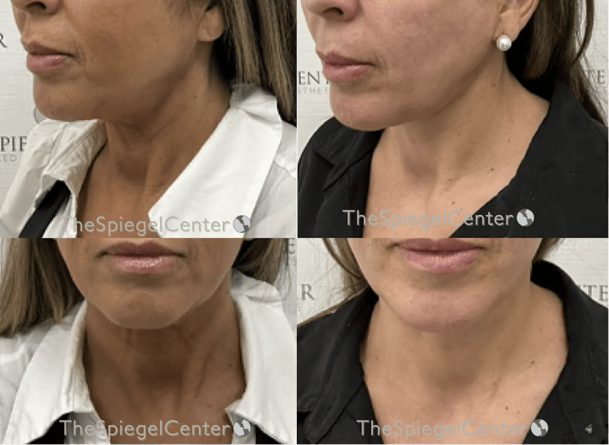 Neck Lift Before & After Gallery - Patient 383106 - Image 1