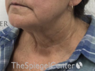 Neck Lift Before & After Gallery - Patient 215444 - Image 1