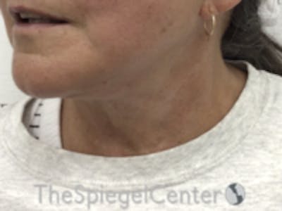 Neck Lift Before & After Gallery - Patient 215444 - Image 2