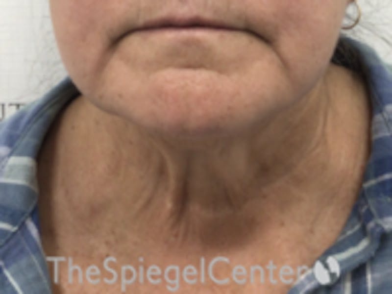 Neck Lift Before & After Gallery - Patient 215444 - Image 3