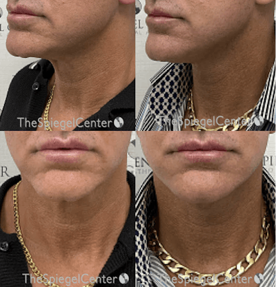 Neck Lift Before & After Gallery - Patient 148930 - Image 1