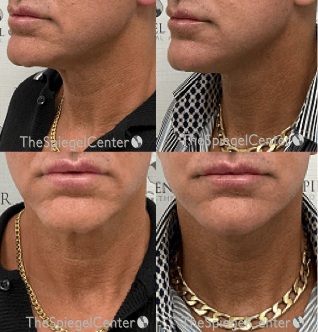 Neck Lift Before & After Gallery - Patient 148930 - Image 1