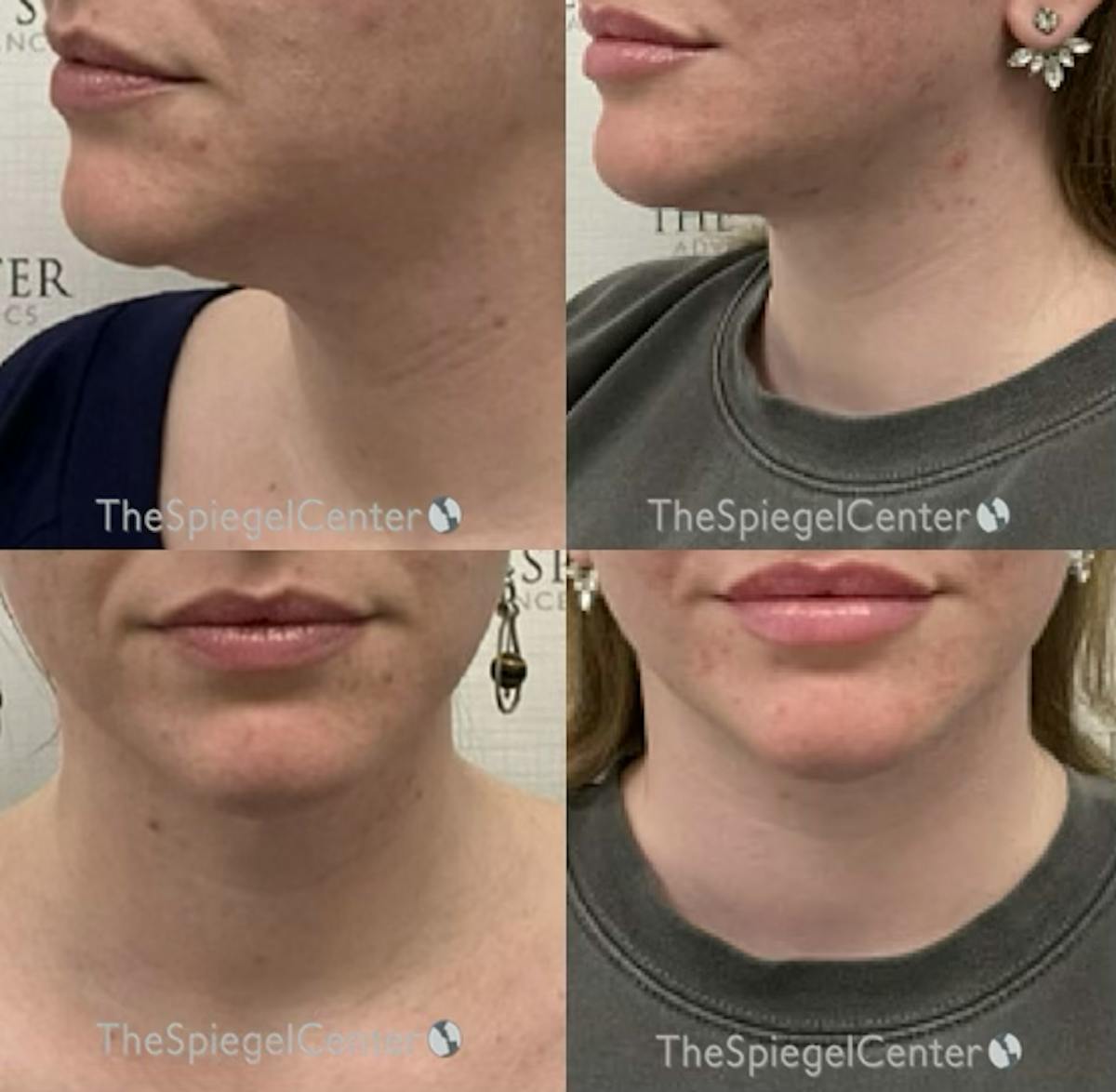 Neck Lift Before & After Gallery - Patient 119543 - Image 1