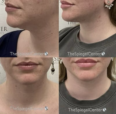 Neck Lift Before & After Gallery - Patient 119543 - Image 1