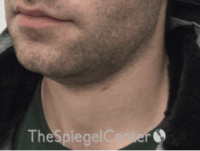 Neck Lift Before & After Gallery - Patient 339279 - Image 1