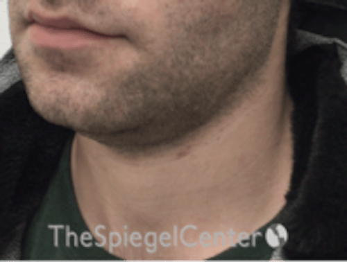 Neck Lift Before & After Gallery - Patient 339279 - Image 1