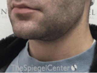 Neck Lift Before & After Gallery - Patient 339279 - Image 2