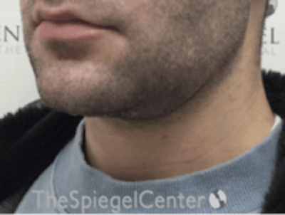 Neck Lift Before & After Gallery - Patient 339279 - Image 2