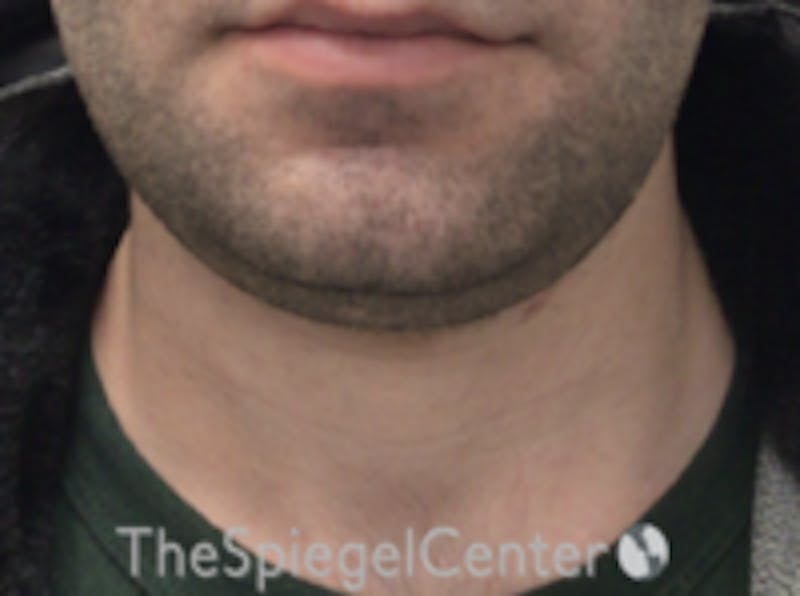 Neck Lift Before & After Gallery - Patient 339279 - Image 3