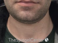 Neck Lift Before & After Gallery - Patient 339279 - Image 3