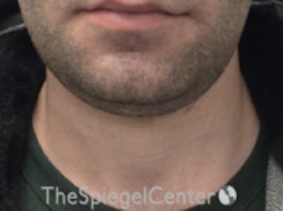 Neck Lift Before & After Gallery - Patient 339279 - Image 3