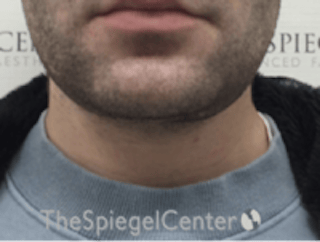 Neck Lift Before & After Gallery - Patient 339279 - Image 4