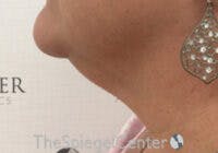Neck Lift Before & After Gallery - Patient 247300 - Image 1